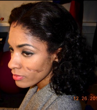 Alicia Hall Moran as Bess u/s
The Gershwins’ Porgy and Bess
Broadway
Makeup and Scarring
